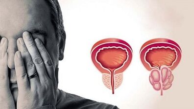 As razóns para o desenvolvemento da prostatite nos homes